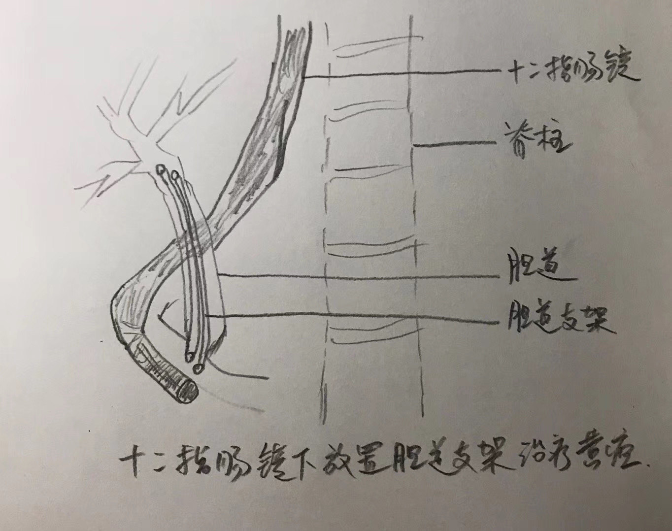 内镜下(ercp)胆管支架置入治疗梗阻性黄疸 - 好大夫在线