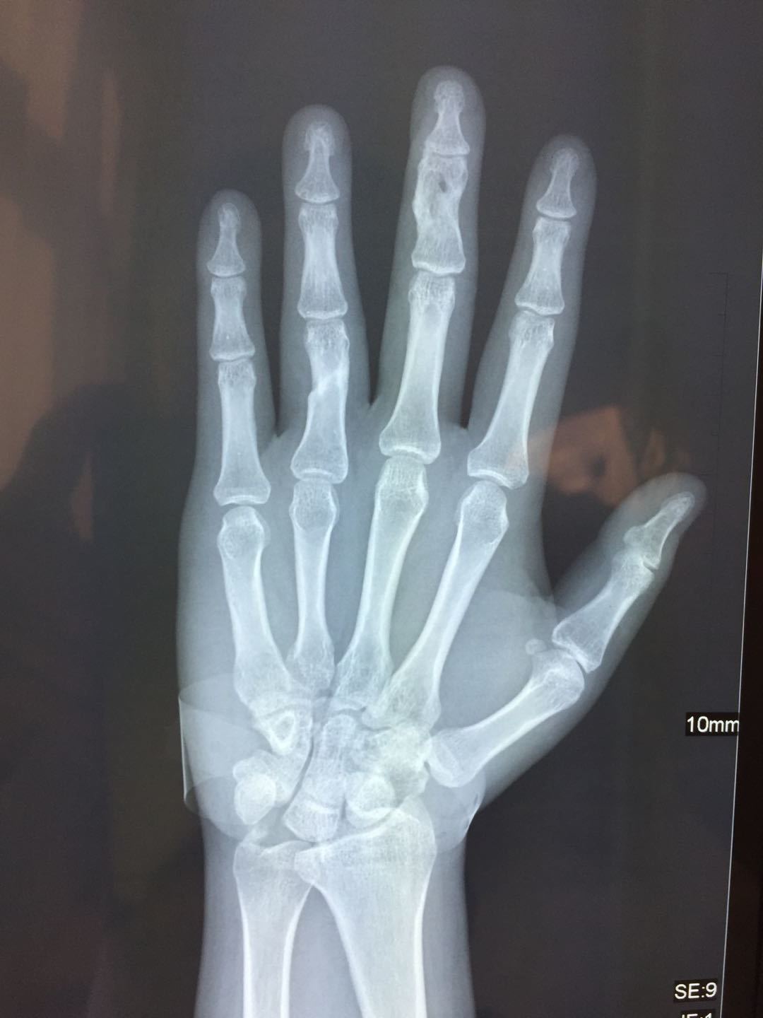 手指骨裂图片 x光图片