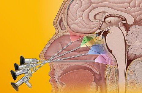 垂体瘤经鼻蝶内镜手术介绍