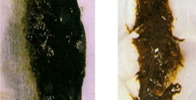 大便发黑,什么情况?