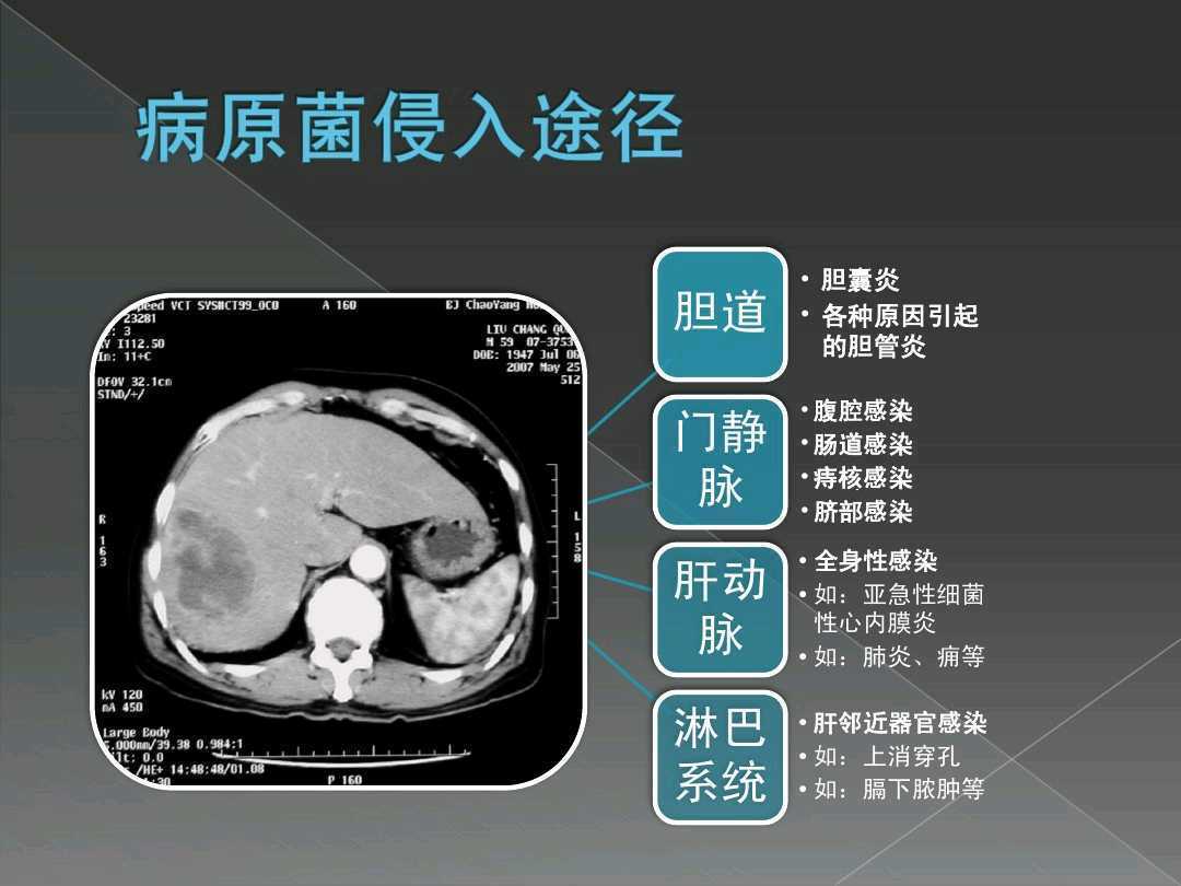 肝脓肿ppt图片