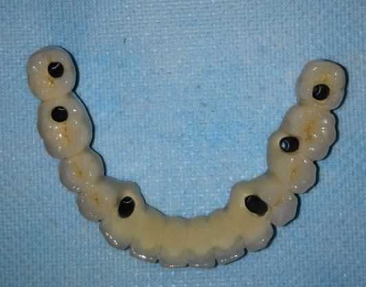 牙齿种植_牙齿种植治疗方式 - 好大夫在线