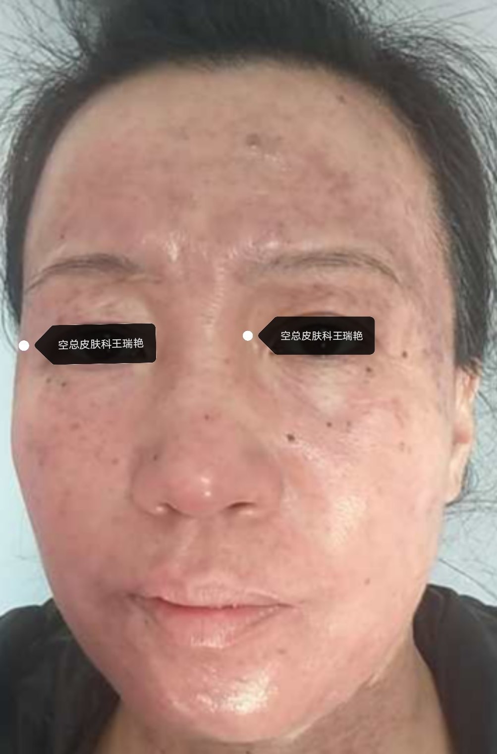 重度玫瑰痤疮治疗2个月后