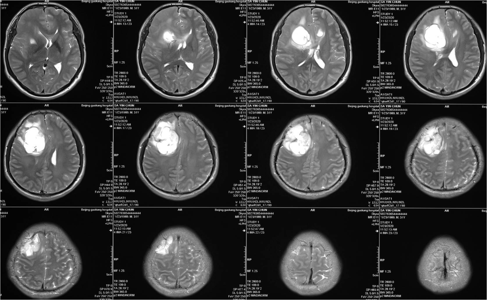 高级别胶质瘤的扩大切除 - 好大夫在线