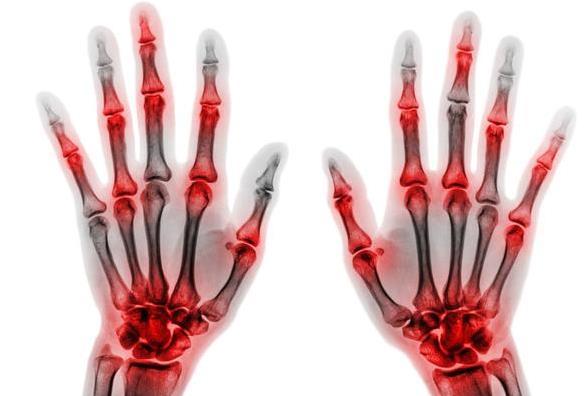 手指骨折进行治疗后 需要做什么 骨折 手指骨折进行治疗后 需要做什么 骨折