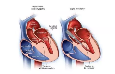 肥厚型心肌病图解图片