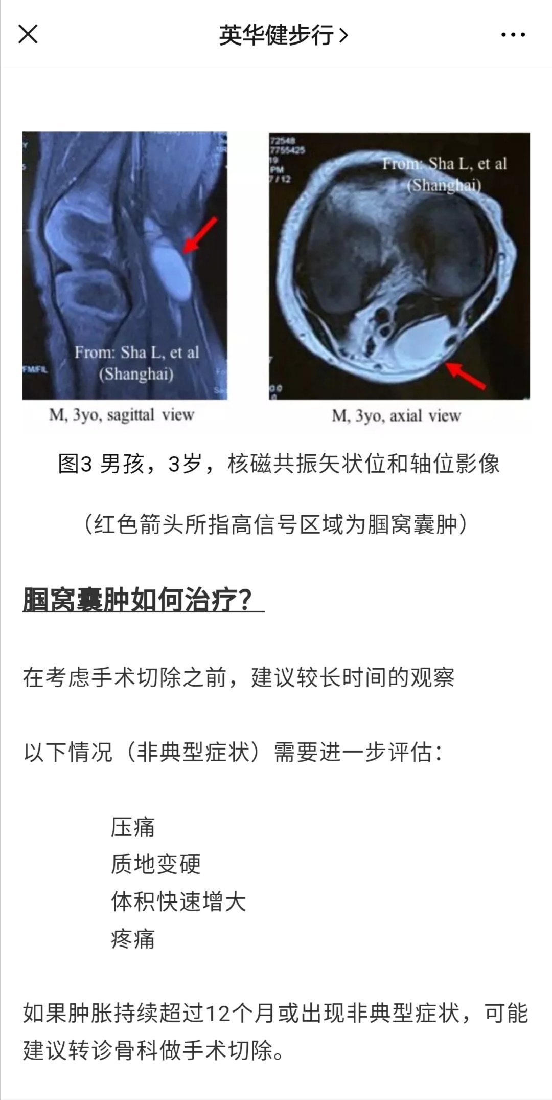 腘窝囊肿(poplitealcyst)