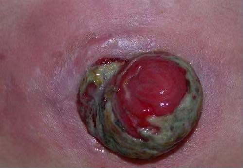 造口护理中底盘黏胶对品质生活的影响有哪些?