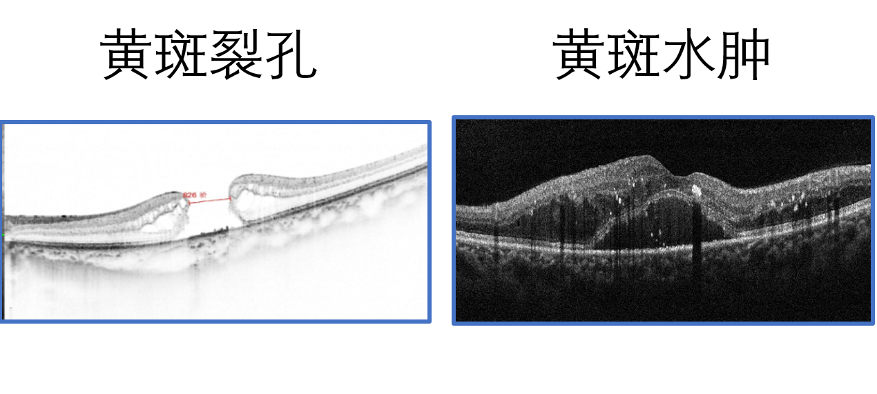 黃斑裂孔-水腫-oct.png