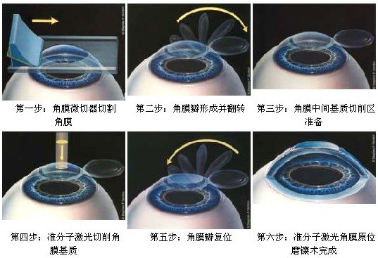 具體可分為:角膜,鞏膜,角膜緣,前房角.