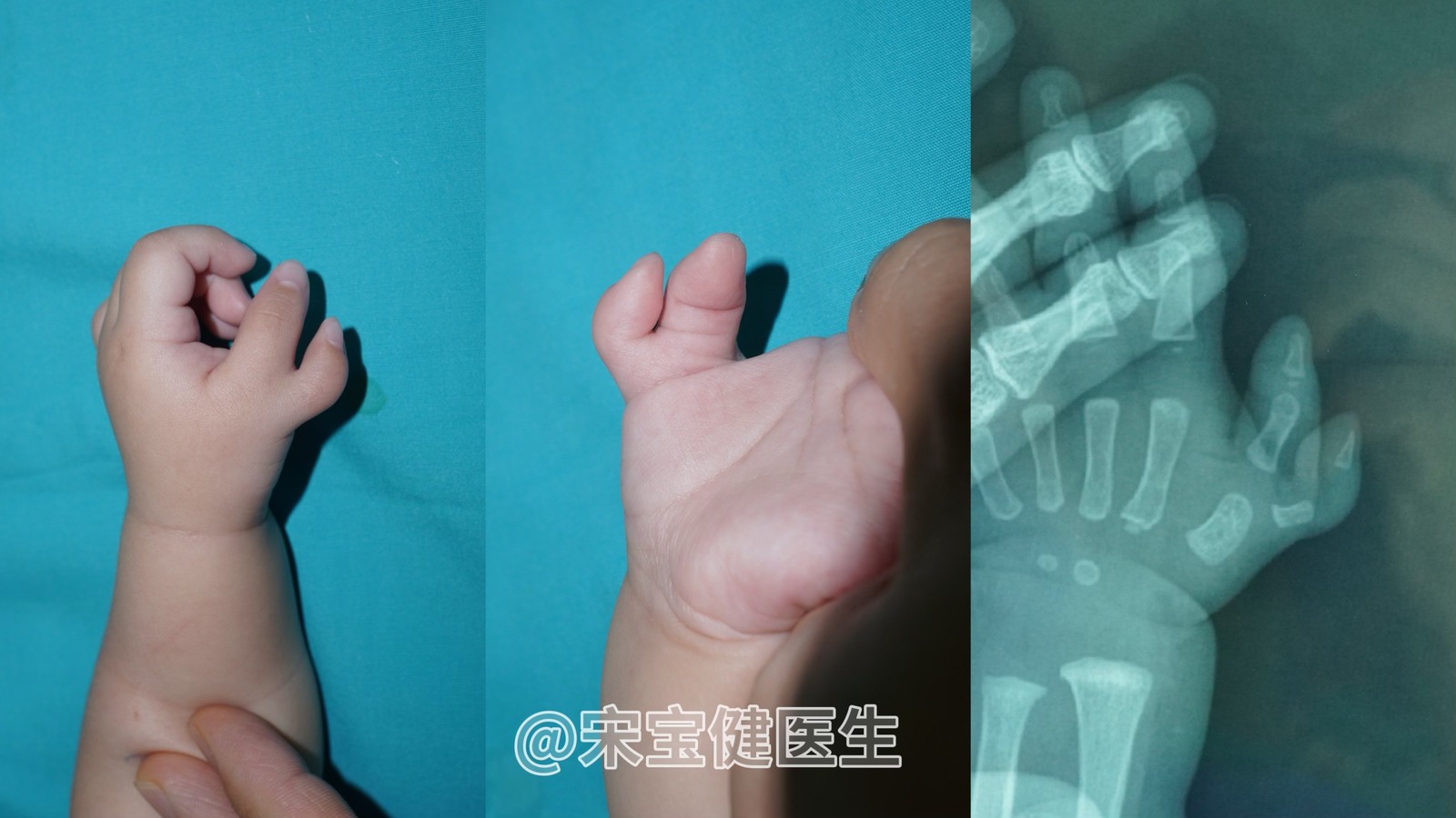 多指畸形常见类型案例分享 - 好大夫在线