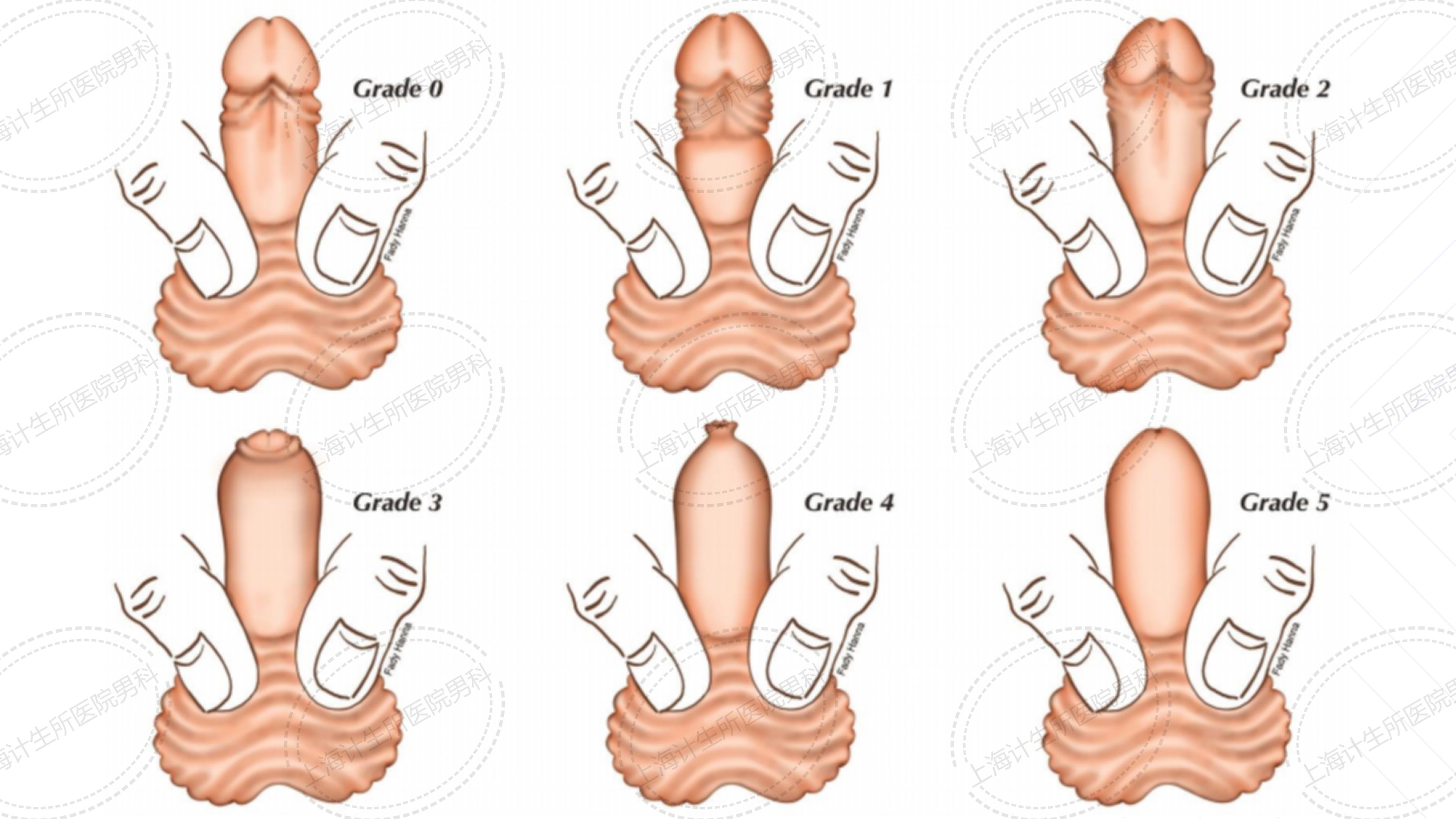 包茎——袖套式包皮环切术真实案例分享