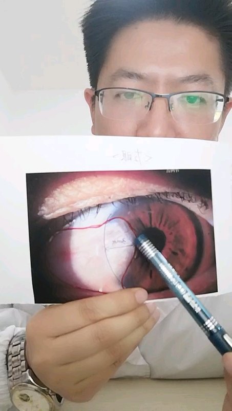 翼状胬肉到底什么时候做手术可取？