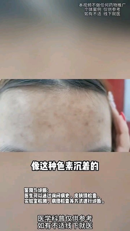 额头长痘留下的黑色痘印如何去除