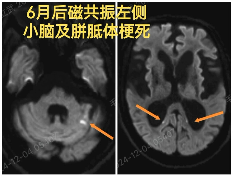 6个月内基底动脉由中度狭窄进展为闭塞，急诊取栓并置入支架