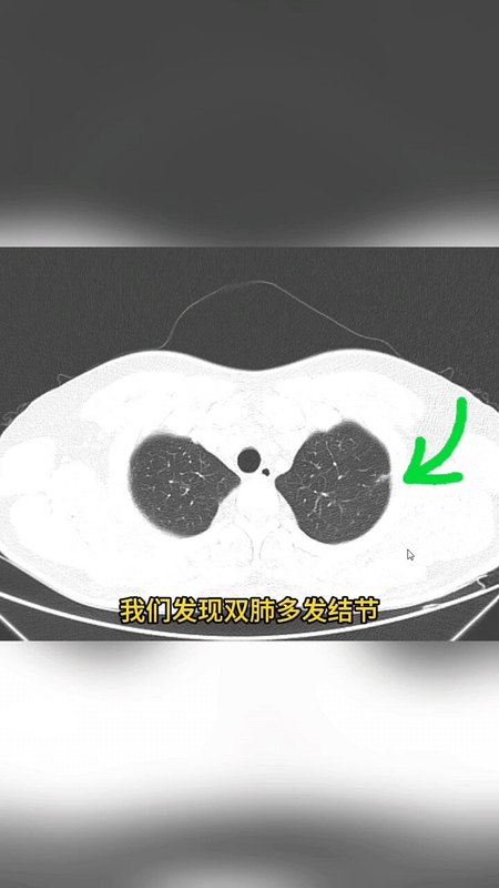 结节病诊断与治疗