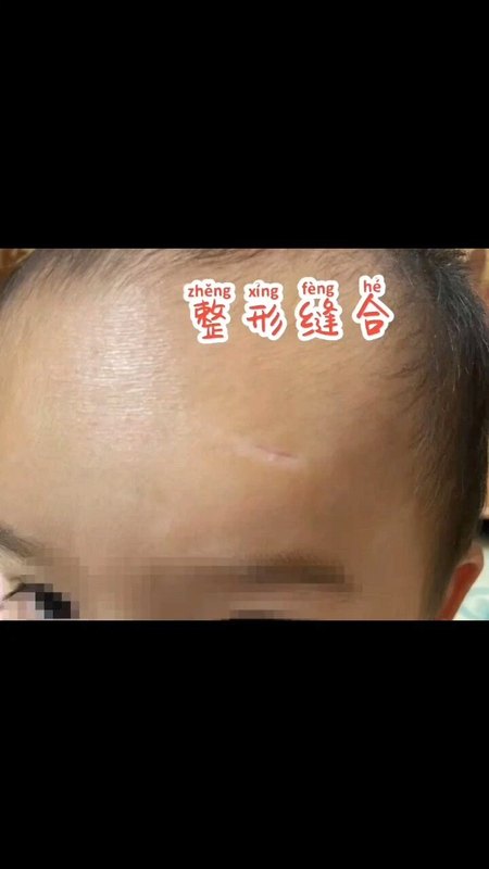 北京儿童医院李丹医生，整形缝合效果展示～
                    每周四上午烧伤整形科普通门诊～