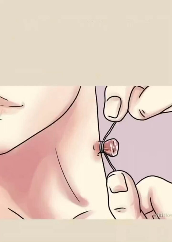 丝状疣和皮赘，如何处置更好？