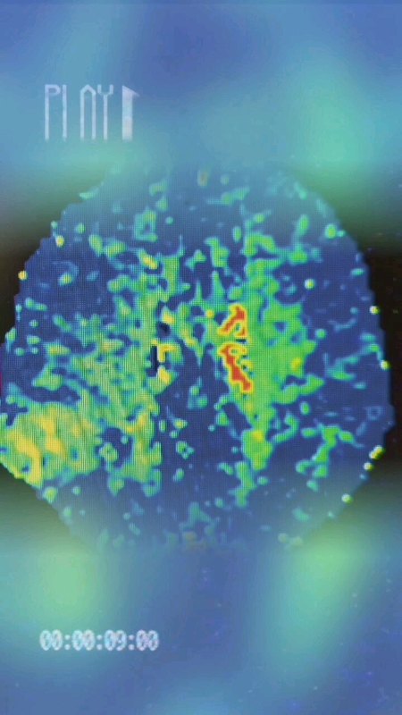 脑胶质瘤，扩大切除后，功能正常…