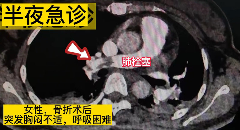 突发胸闷气短，当心肺栓塞