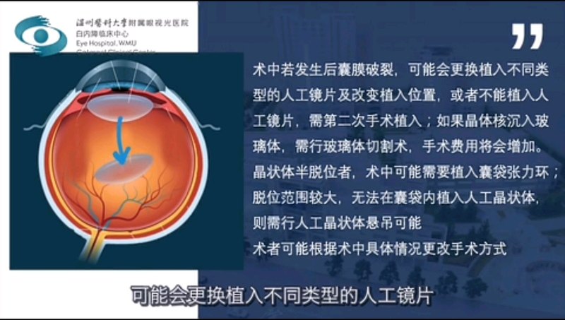 白内障术前谈话（二）