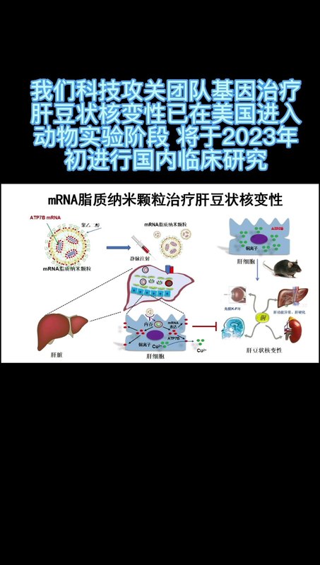 基因治疗肝豆状核变性新进展