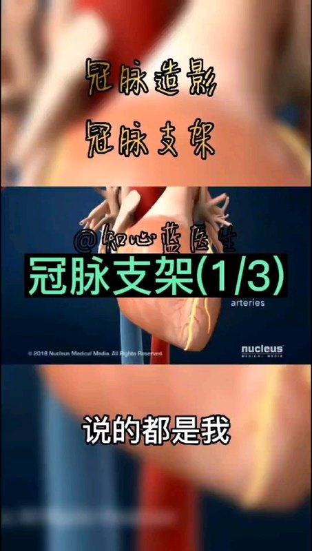 冠心病，冠脉造影，冠脉支架，动画演示