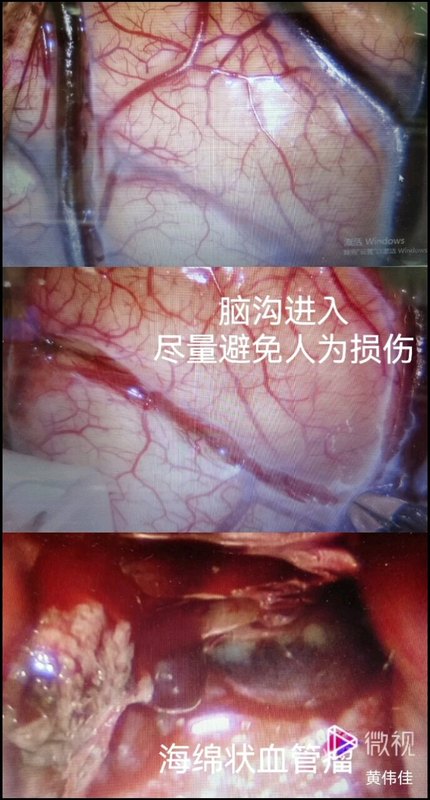 功能区海绵状血管瘤
                    从自然脑沟进去切除，不增加副损伤