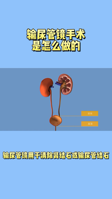 没有刀口的输尿管镜是如何把结石取出来的