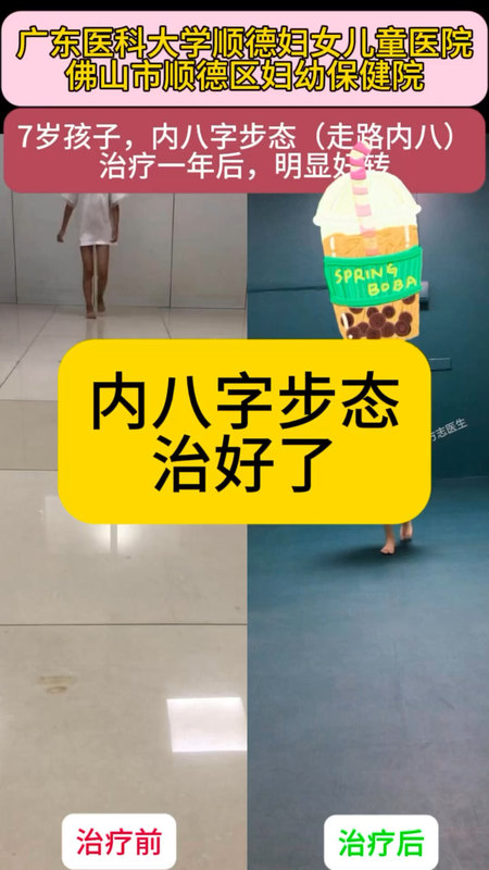7岁孩子，内八字走路（走路内八字），治疗一年后，明显好转。