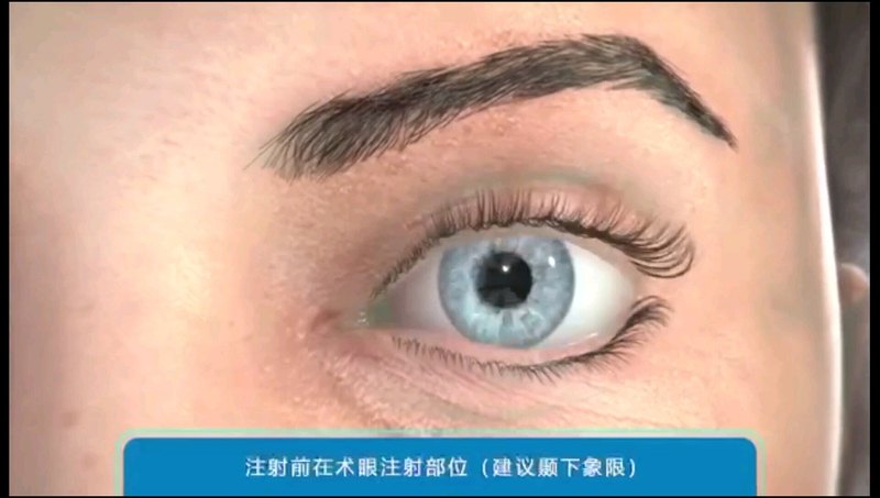 慢性非感染性葡萄膜炎的新选择—氟轻松玻璃体内植入剂