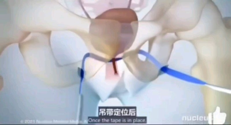 压力性尿失禁手术演示！