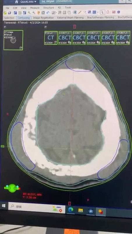 颅骨转移放疗