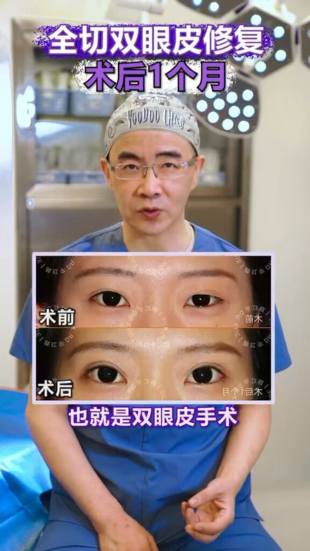 全切双眼皮修复术后1个月分享
                    （案例中求美者已授权）