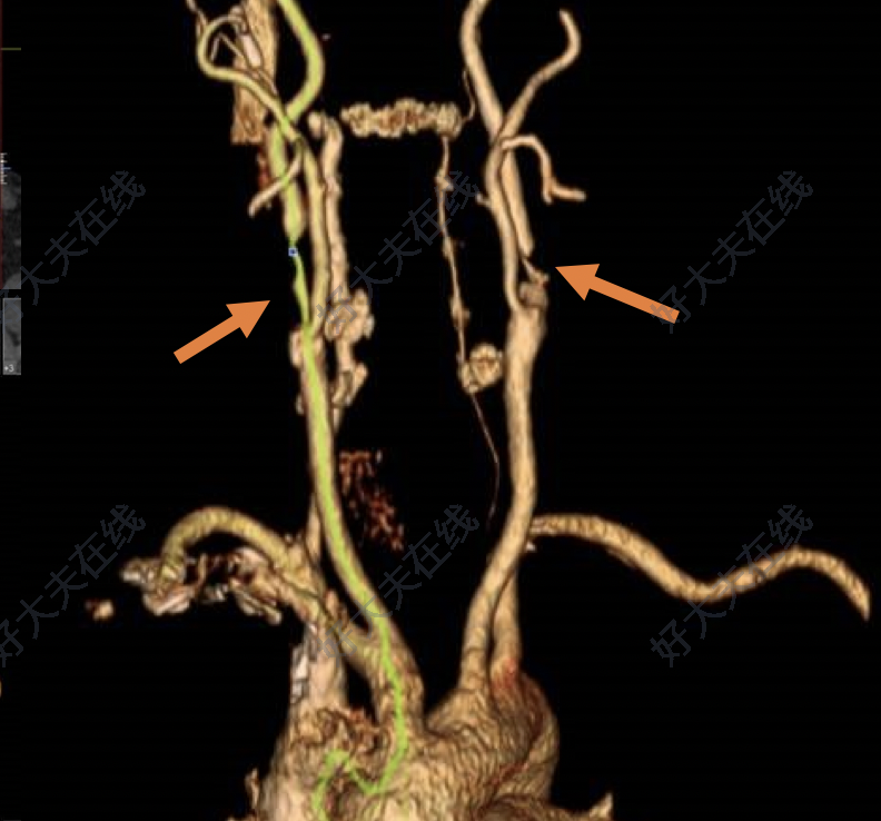 安贞医院医院咨询核磁加急-北京安贞医院做ct几天出结果 