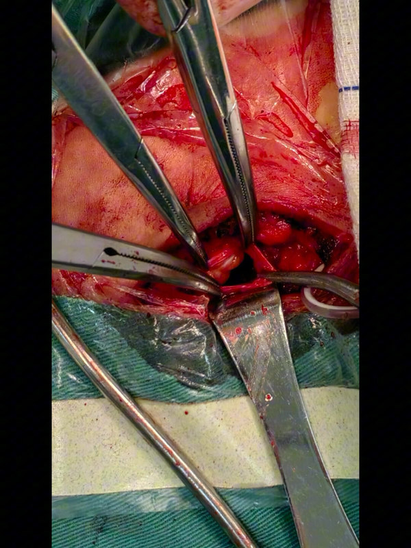 脑室腹腔分流术后管子外置