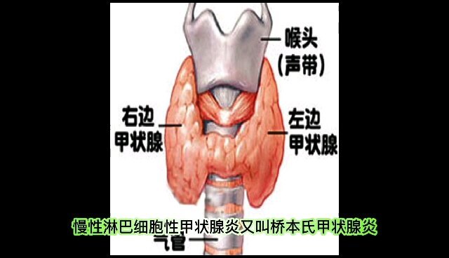 什么是淋巴性甲状腺炎？
