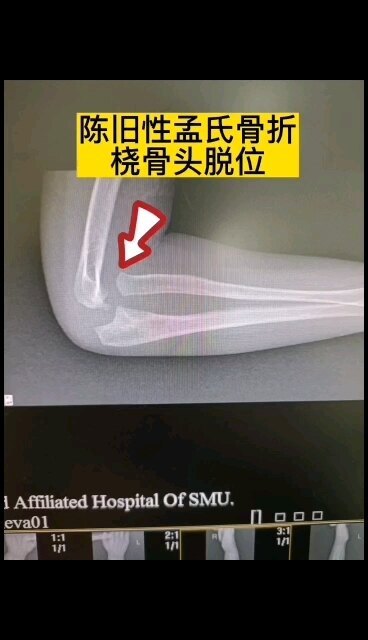 孩子胳膊外伤后骨折，以为就是一个骨折，打了石膏骨折好了，但桡骨头却脱位了，这是桡骨头脱位。