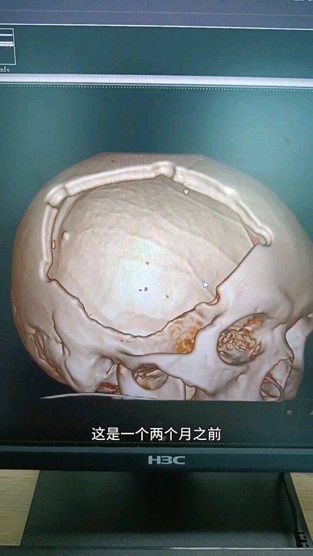 自体颅骨修补的优势