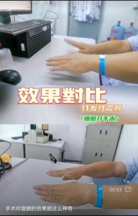 震颤微创手术前后对比