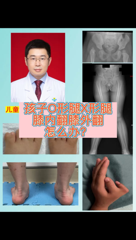 孩子膝内翻、膝外翻、X形腿、O形腿怎么办？