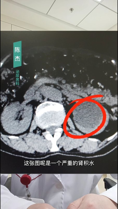 输尿管结石不疼了该怎么办