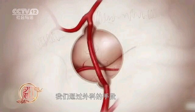 烟雾病的多因素贴覆手术怎么做？