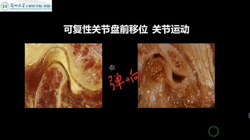 颞下颌关节紊乱病发展全过程