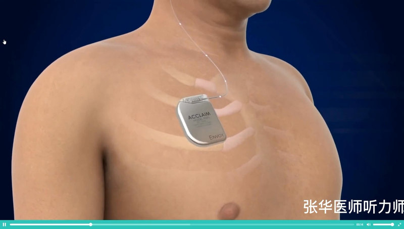 2022.11.1最新报告。美国第一台实验性全植入人工耳蜗手术成功。电池植入在胸前。