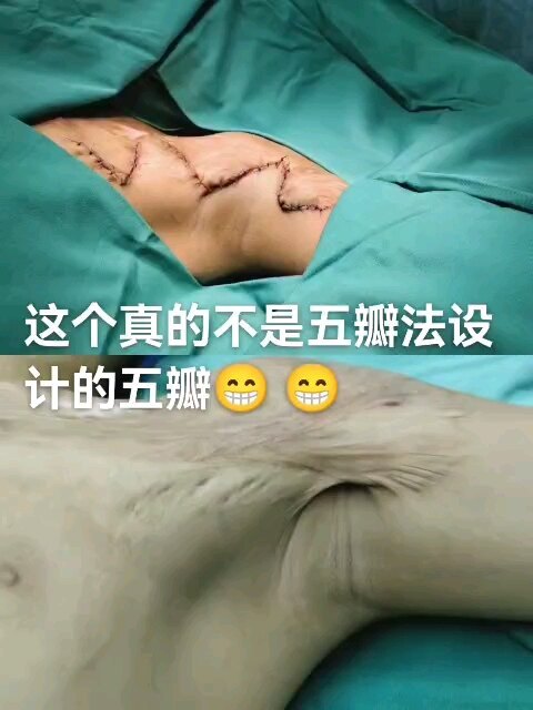 腋窝桥状瘢痕皮瓣修复