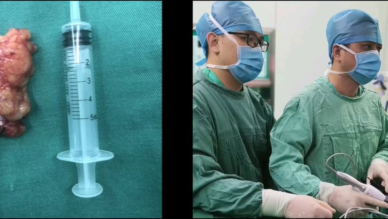 肾上腺腺瘤合并高血压的微创手术治疗。患者年龄偏大，但手术依然安全可耐受。