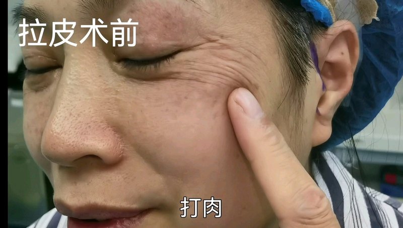 眼角纹通过拉皮可以减轻但不能完全去除