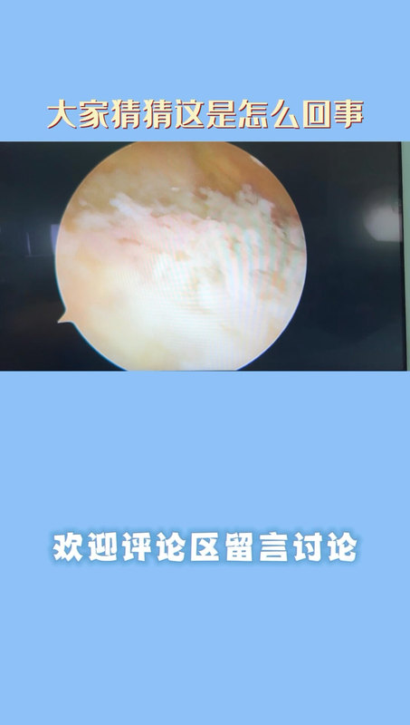 膝关节内滑膜病变：病理结果显示为滑膜软骨瘤病