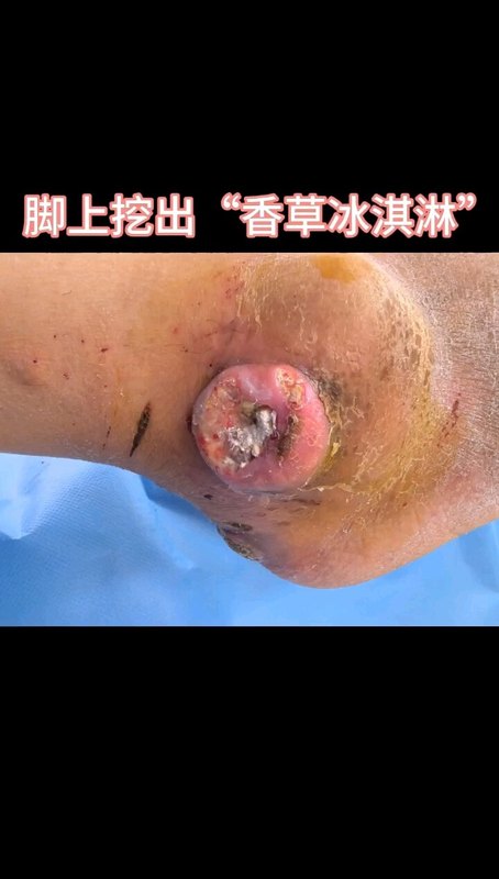 脚上挖出香草冰淇淋